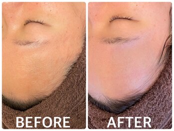 ハーブピーリング 心斎橋/ハーブピーリングで毛穴ケア