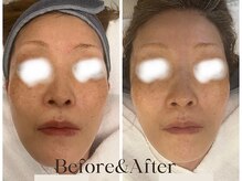 トウキョウビューティーラボ(TOKYO BEAUTY LABO.)/スノーピールBefore&After