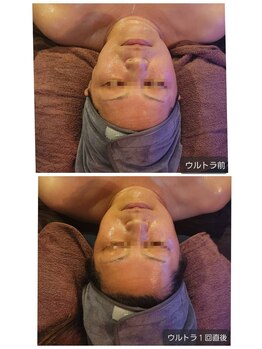 ヴィトワ(Vitowa)/ウルトランスフォーマー施術例6