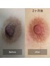 【ホットペッパー限定クーポン ローマピンク乳輪/乳頭￥220,000→￥132,000】