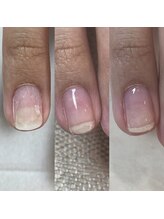フェミニンネイル(Feminine Nail)/剥離した爪