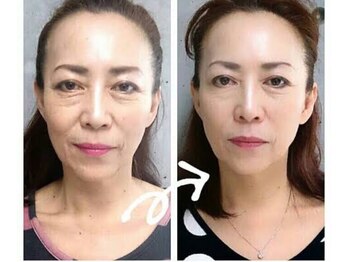 アンジュクーレ(Ange 90)/ハーブピーリング