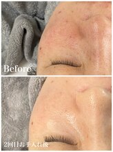 ピュア 川越店/光フェイシャル