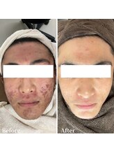 ニキビケア研究所 所沢店/メンズニキビでお悩みの方へ