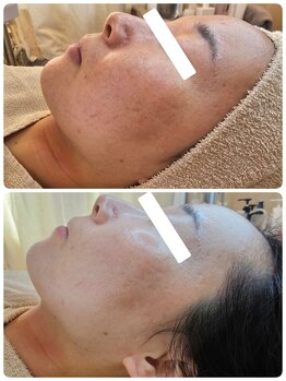 クレイルサロン(Claire salon)/本気の肌質改善ハーブピーリング