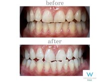 ホワイトニングショップ 町田店/【ビフォーアフター】1回