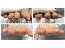 ミコ(.mico)の雰囲気（自爪育成、深爪、巻き爪、変形爪の補正や再生を行っております。）
