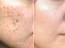 育肌美研 自由が丘サロン/ニキビケア｜ハーブピーリング