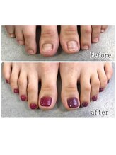 ティアラネイル 宇都宮/フット深爪矯正