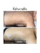 ビューティリュクス(beauty luxe)/滑らかな背中に！！