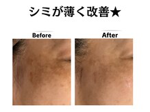 グレースティー 森町 箕面/濃かったシミが薄く改善！★