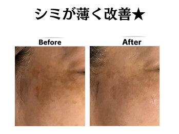 グレースティー 森町 箕面/濃かったシミが薄く改善！★