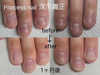 プリンセスネイル(Princess nail)/深爪矯正1ヶ月後