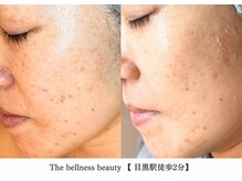 ザ ベルネス(The bellness)/【セルマン】肌改善・ピーリング