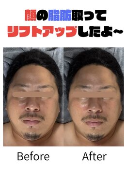 ララナ バイ カノア(LALANA by kanoa)/顔小さくなったよ～！