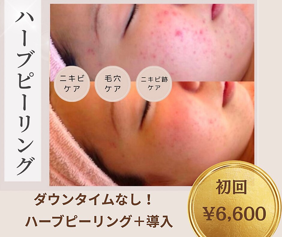 11ページ目｜ハーブピーリング 剥離 あり 東京に関するエステサロン