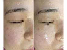 バタフライ 津田沼店(Butterfly)/Butterflyのハーブピーリング