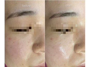 バタフライ 津田沼店(Butterfly)/Butterflyのハーブピーリング