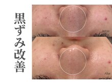 エトレ(etre)/月１サロン/毛穴/黒ずみ/肌管理