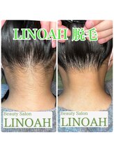 ビューティーサロン リノア(LINOAH)/◎結果重視◎【うなじ脱毛】