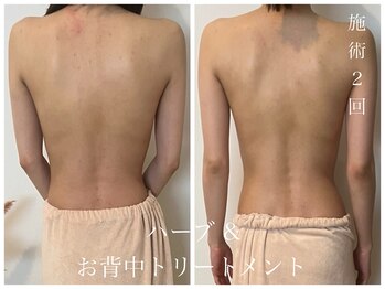 ダン(dan)/【背中陶肌トリートメント】症例