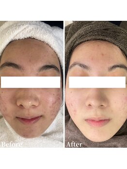 ニキビケア研究所 所沢店/頬ニキビでお悩みの方へ