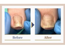 巻き爪補正店 錦糸町店/【巻き爪補正】