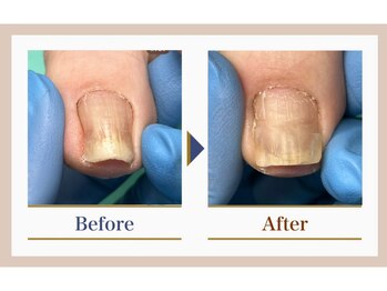巻き爪補正店 錦糸町店/【巻き爪補正】