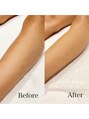 レ ベージュ(L’Beige)&nbsp;人気の足腕脱毛。1回目で効果を実感していただく方が多い◎