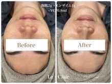 スキンセラピーサロン ル クレール(Le Clair)/Before→After