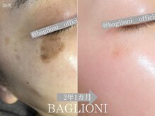 メディカルサロン バリオーニ/目元のシミだけじゃない！