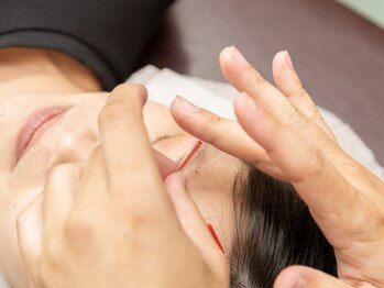 紬はりきゅう接骨院の写真/お悩みのエイジングサイン…美容鍼でお顔をしっかりリフトアップいたします。上質な癒し空間でリラックス◎