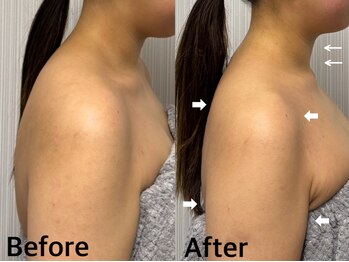 ベール(BEHL)/コルギのBefore After