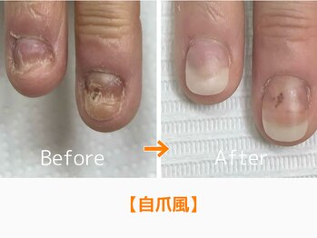 レアム/お爪の凹みも埋めて仕上げます。