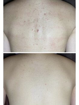 チュチュ(TUTU)の写真/【夏に向けた背中ケア】おしゃれも肌見せも楽しめるツルツルBODYに★ブライダルケアもお任せください