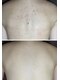 チュチュ(TUTU)の写真/【夏に向けた背中ケア】おしゃれも肌見せも楽しめるツルツルBODYに★ブライダルケアもお任せください