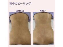 エステティック シャララ(Sha la la)/背中のザラつきや肌色の改善に