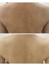 カルディエ(Cardie)/BODYハーブピーリング