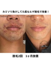イエス 佐賀店(YES)/ヒゲ脱毛ビフォーアフター