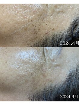 ラリマ(La-lima)/60代女性/たるみケア/シミケア