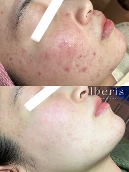 イベリス(Iberis)/ハーブピーリング/赤み改善