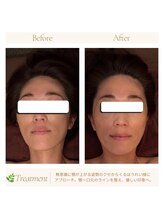 ローズボディ 恵比寿店/そのほうれい線、スマホ首が原因