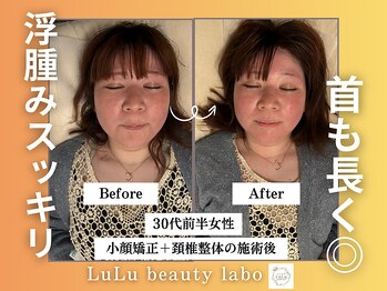 ルルラボ(LuLu beauty labo)/お顔の張りと浮腫みスッキリ♪