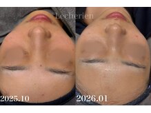 ルシェリア(Le cherien)/ハーブピーリング3回