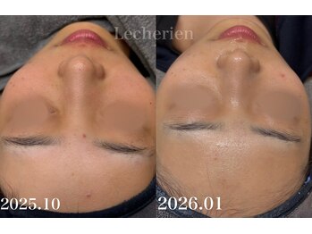 ルシェリア(Le cherien)/ハーブピーリング3回