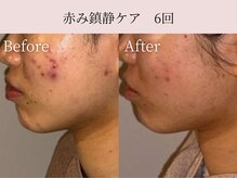 ミア(miiia)/赤み鎮静ケア　6回
