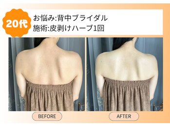 ムーンサン(Moon sun)/お背中 皮剥けハーブ 1回