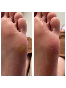 快歩堂フットケアセンター 日本橋館/歩くとツラい魚の目も◎