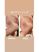 エミルカ(EMILUCA)/ハイドラフェイシャル