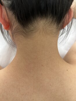 エンドモウ(END MOU)/うなじもスッキリに!